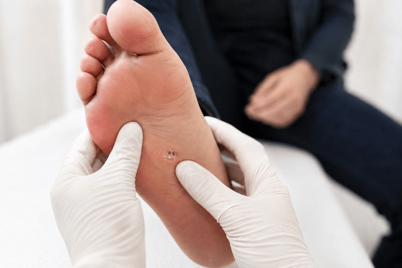 Persona che osserva una verruca sulla mano mentre un dermatologo esamina la pelle in uno studio medico moderno. Immagine fotografica realistica dedicata alla prevenzione e alla cura delle verruche.