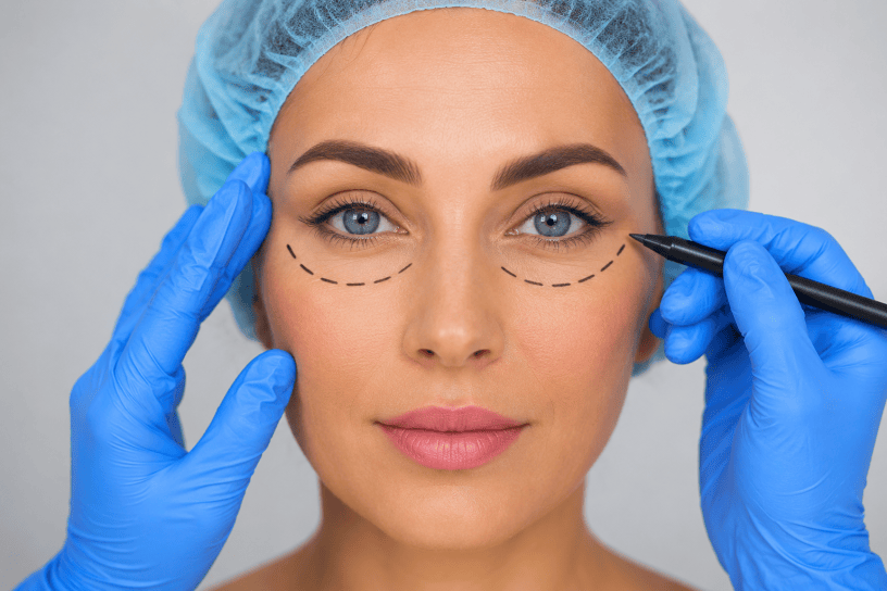 Paziente durante la visita preoperatoria per blefaroplastica con marcature estetiche sotto gli occhi eseguite da un medico specialista in chirurgia plastica.